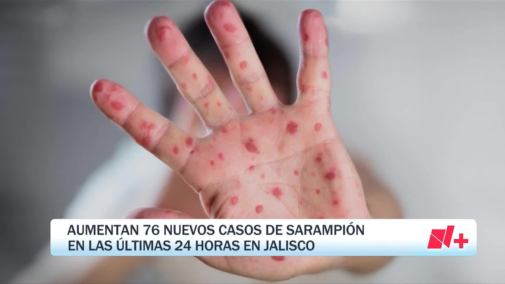 Registran 76 Nuevos Casos de Sarampión Durante un Solo Día en Jalisco