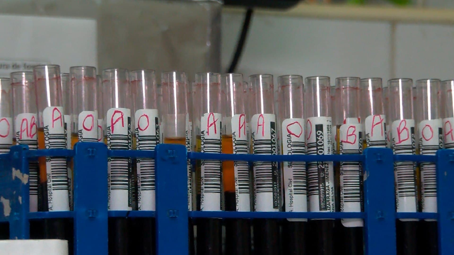 Acusan a Presunto Doctor por Brote de Hepatitis C en Tepatitlán, Jalisco