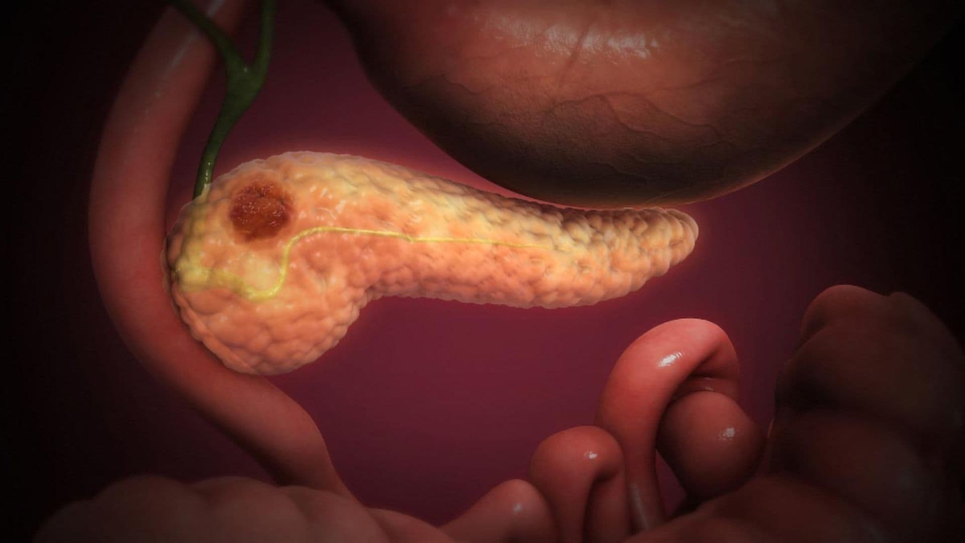 Científicos Españoles Eliminan por Completo Cáncer de Páncreas en Ratones al Combinar 3 Fármacos